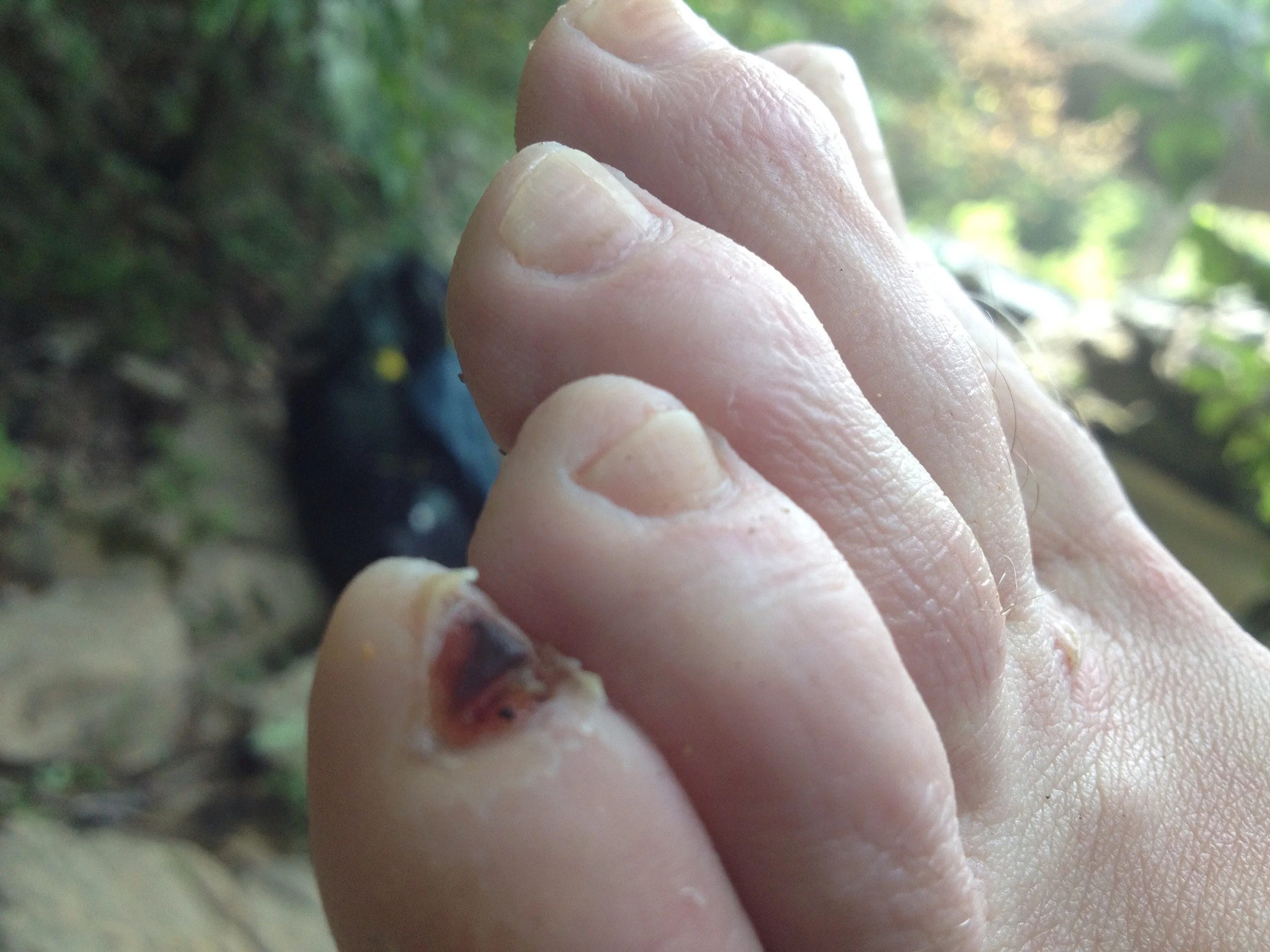 This is the least gross toenail picture I have.