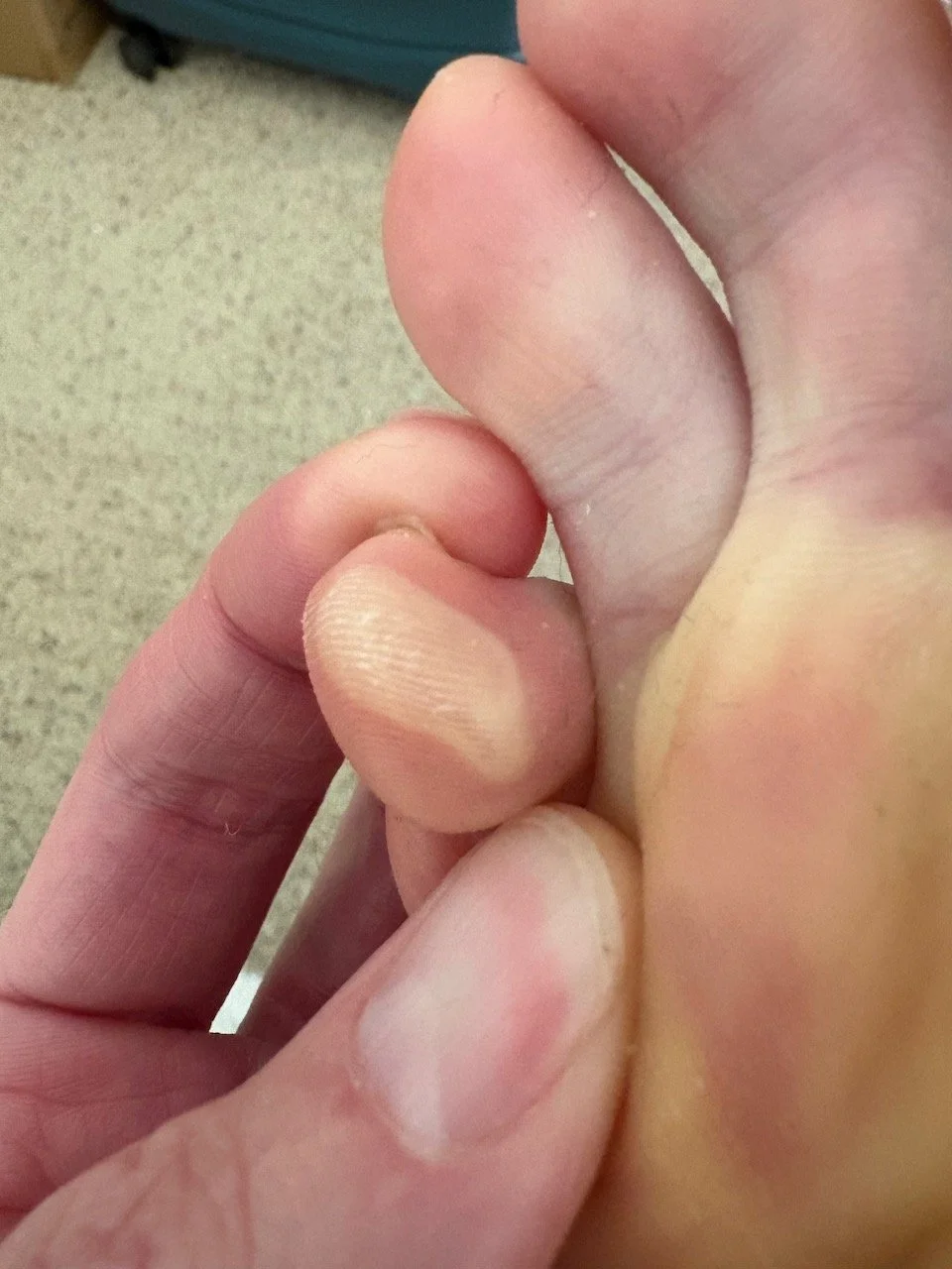  ^ Some gnarly blisters a few days later. You’re welcome. :) 