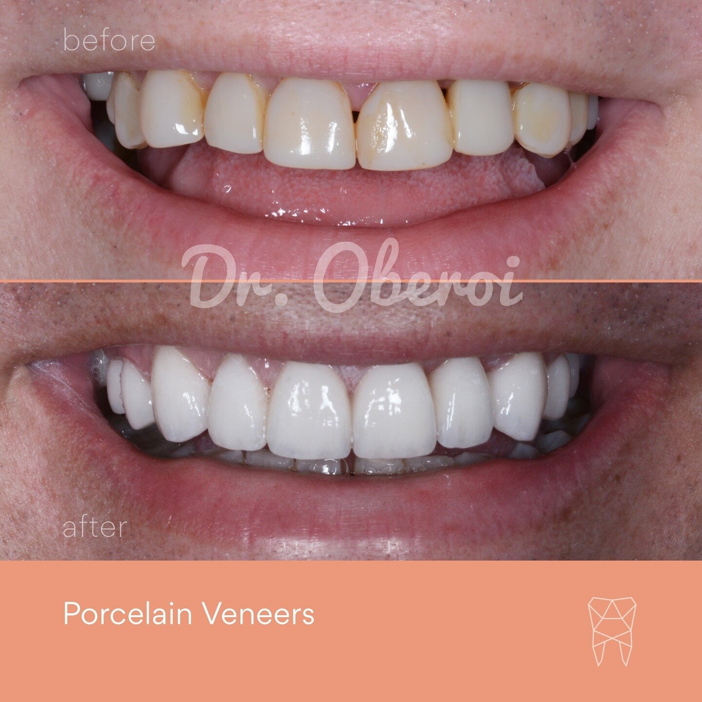 Porcelain Veneers #smilemakeover complete! Our patient went for a beautiful set of natural-looking veneers to replace his existing composite veneers that were looking stained and worn down, what do you think of the results?⁠ 😄
⁠
Considering a smile 