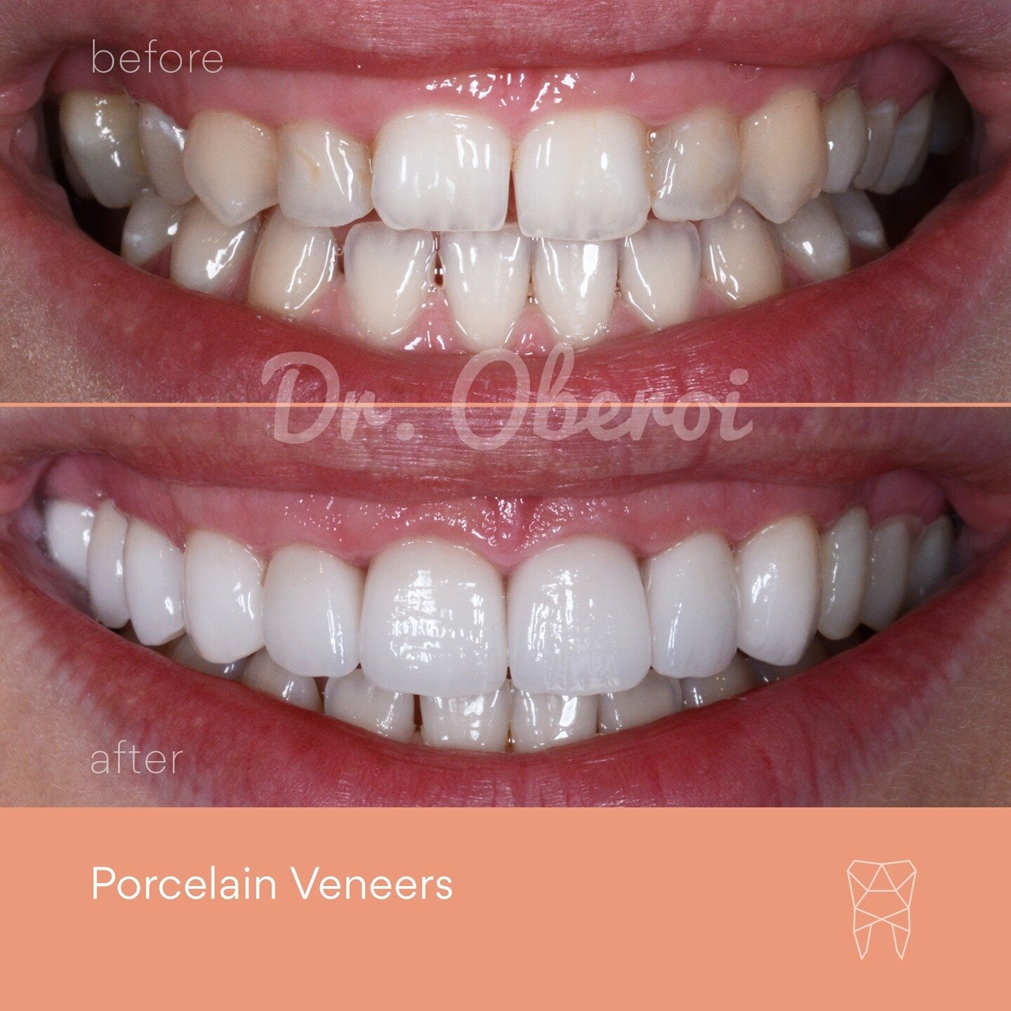 New pearly white porcelain veneers check ✓ What do you think of the results from this #smilemakeover with Dr Oberoi?⁠
⁠
Considering a smile makeover? Smile Now, Pay Later with interest-free payment plans from Afterpay, Openpay &amp; Zip. Enquire or b