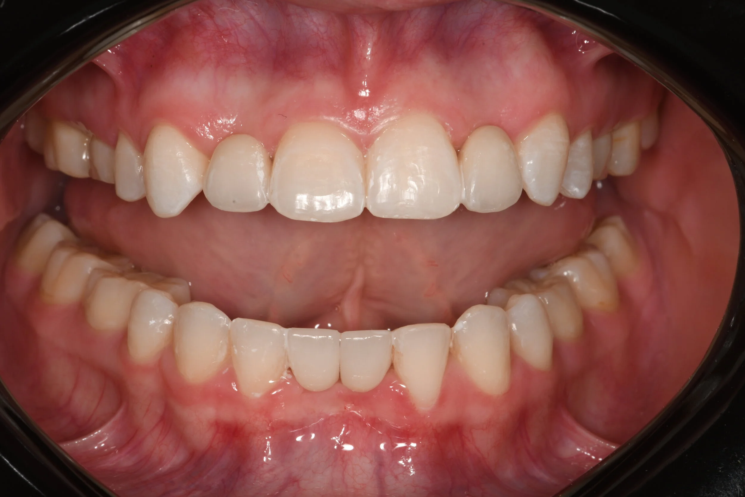 No Prep" Maryland Bridge — O'Shea Dentistry