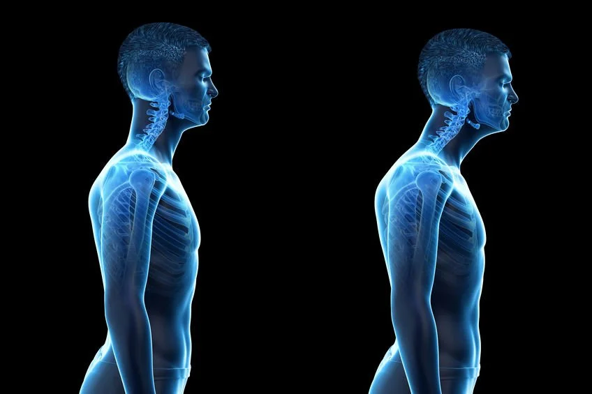 What Is Head Forward Posture and How to Correct It