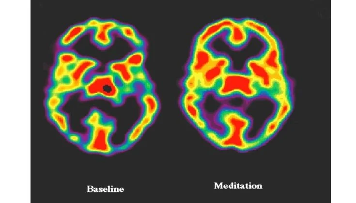 Unlocking the Mind: How Meditation Transforms Your Brain