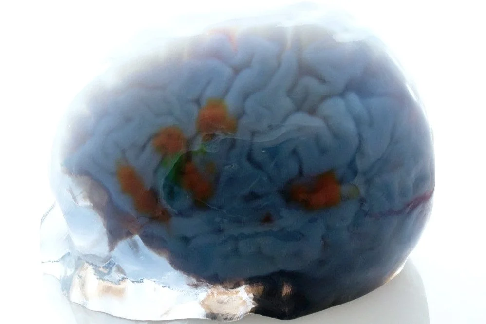 3D Printed Brain with fMRI for Eloquent Area Tumor Ressection. Voxel Printed