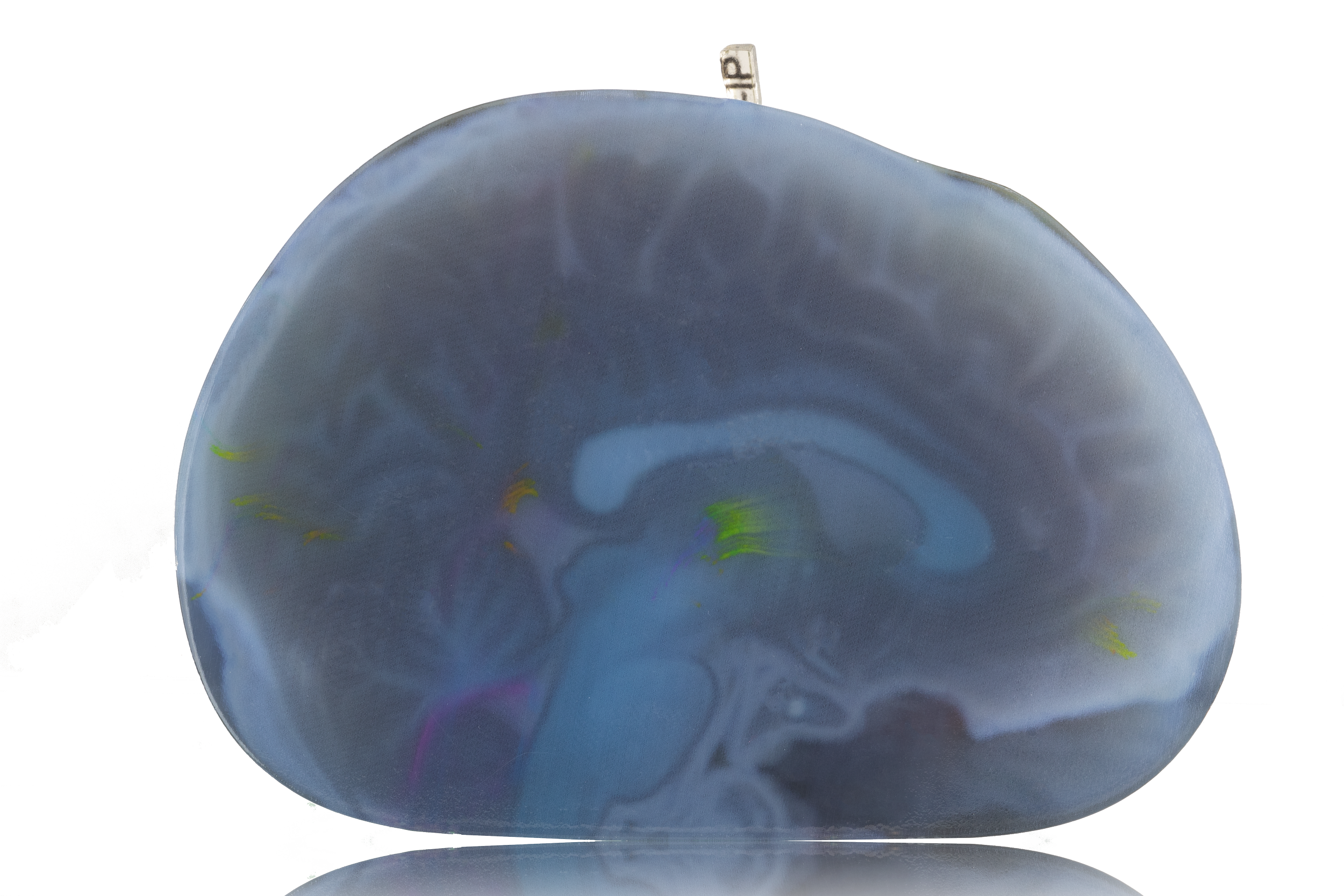 A blue and gray gallstone or kidney stone with a smooth, rounded shape, isolated on a white background.