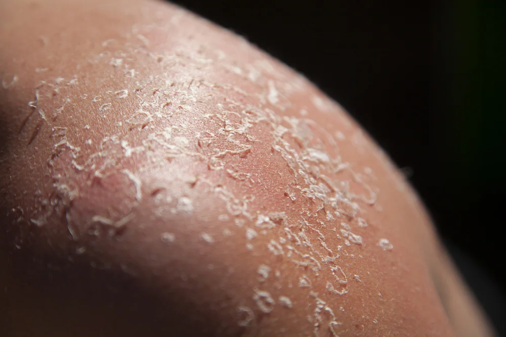 Sunburn