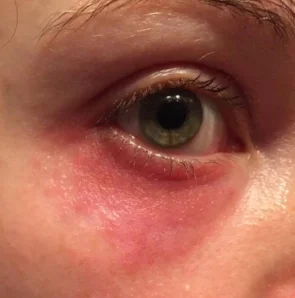 The worst my eye was, was on Sept. 17th...