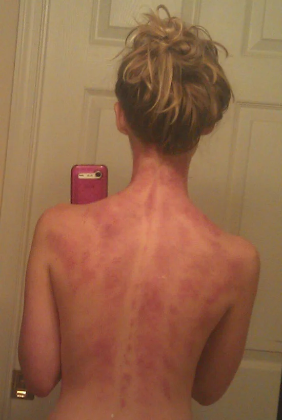 Ancient Healing: Gua Sha