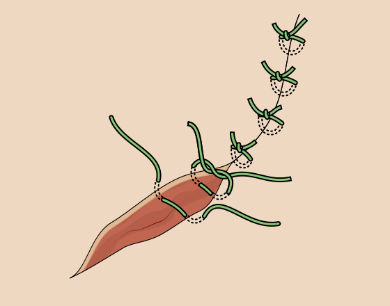 how-to-suture-a-wound.png