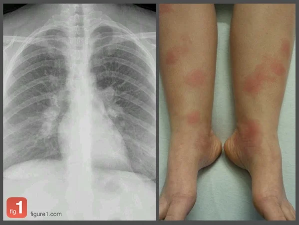 Chest Leads Rash Figure 1 Image of the Week #3 — EM Curious