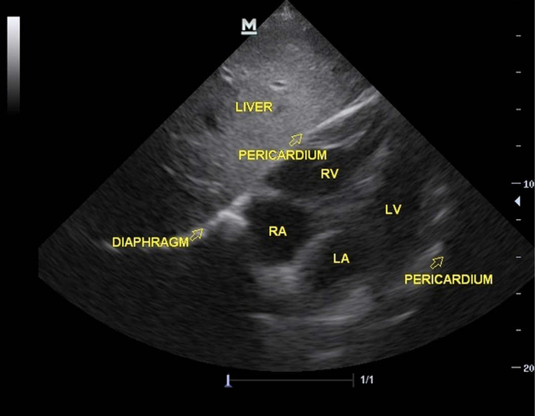 Subcostal View