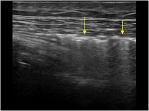 Subcutaneous emphysema