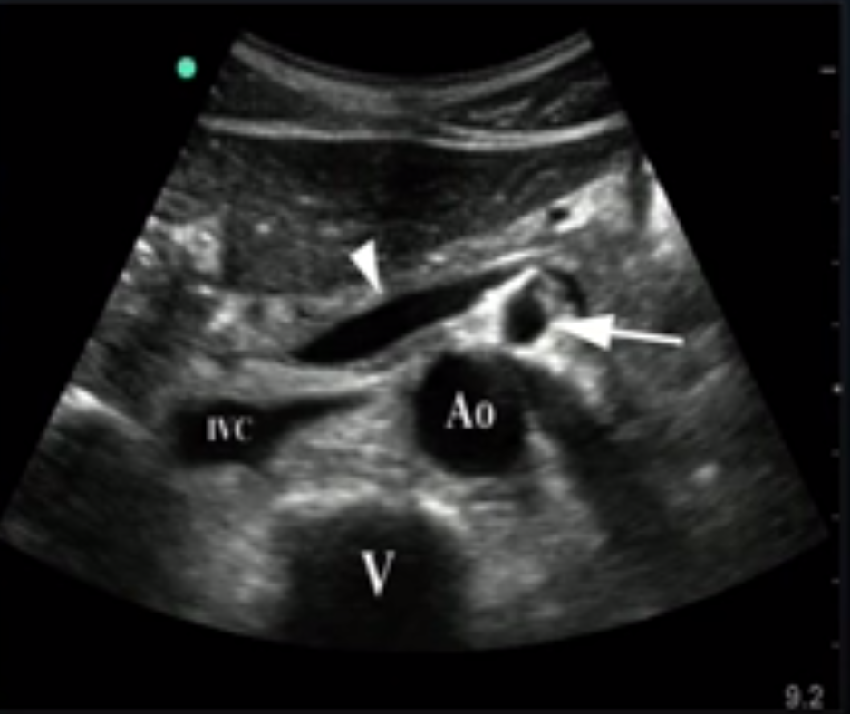 Ultrasound Leadership Academy Aortic Ultrasound Em Curious