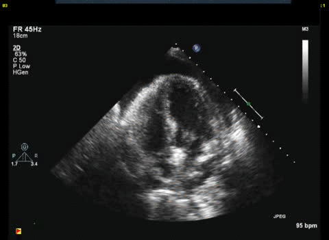 Diastolic RV and RA collapse are both present here, consistent with tamponade physiology. 