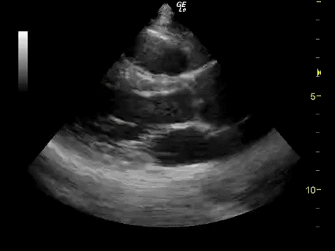 This is a normal PSLA view. Notice nice thickening of anterior and posterior walls which are symmetric during systole. The mitral valve is practically hitting the septum during diastole. 
