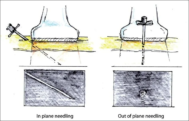 In plane versus out of plane technique. From The International Journal of Shoulder Surgery. 