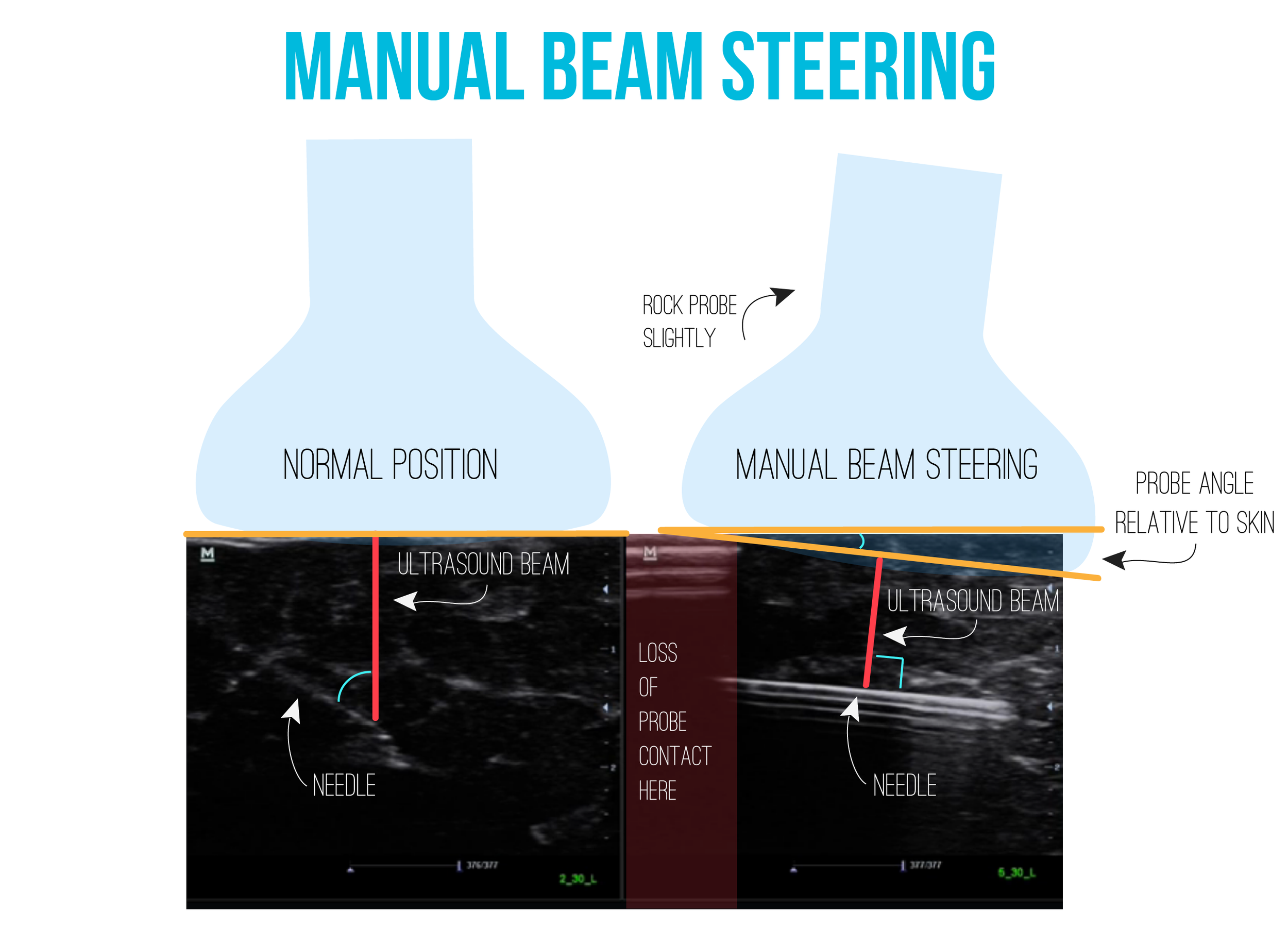 Manual beam steering. Ultrasound image from ULA 'Procedures In-plane.'