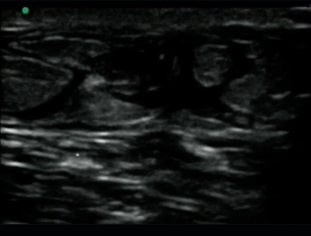 Demonstration of fluid in the superficial soft tissue which would be concerning for extravasation from failed peripheral IV. From ULA 'Peripheral IV Placement' 