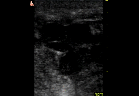 Short axis view along femoral vessel complex over mass. Structures seen here were non compressible