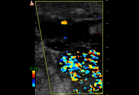 Short axis view along femoral vessel complex over mass, with color doppler. 