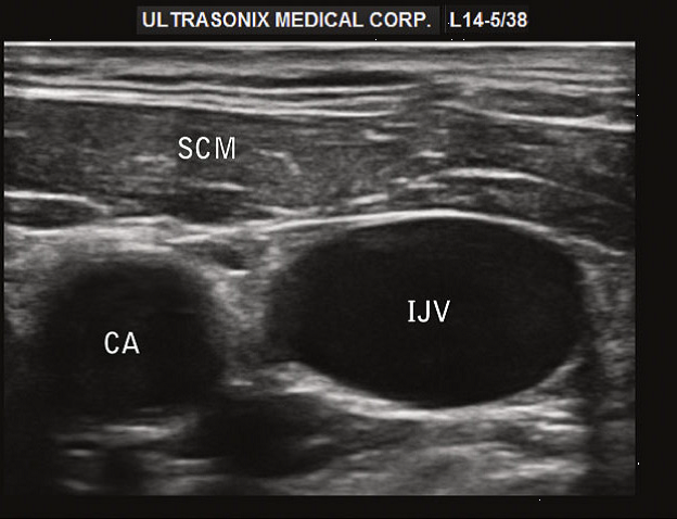Short axis view along the right IJ with the probe marker towards the patient's left side. 
