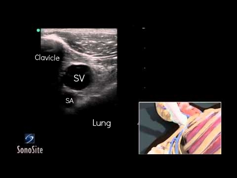 Short axis view of the subclavian, just lateral to the head of the clavicle. Seen here is the clavicle to the left of the screen, the subclavian vein (SV) anteriorly, the subclavian artery (SA) posteriorly, and the lung at the base of the screen. From Sonosite Youtube page. 