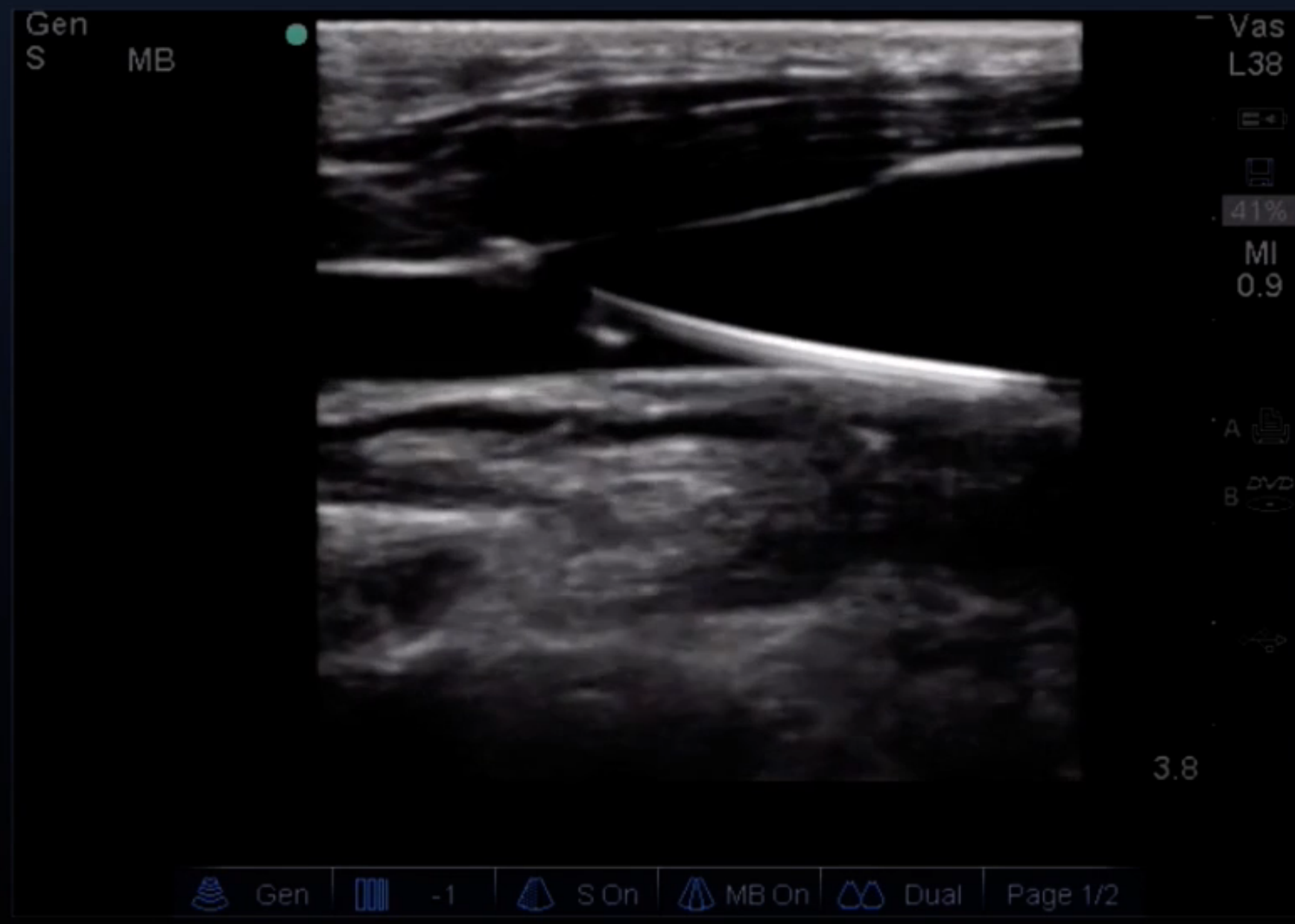 Confirmation of wire placement. The wire is visualized traversing the soft tissue, passing into the vessel lumen and running along the back wall of the vein. From ULA Central Line Placement. 