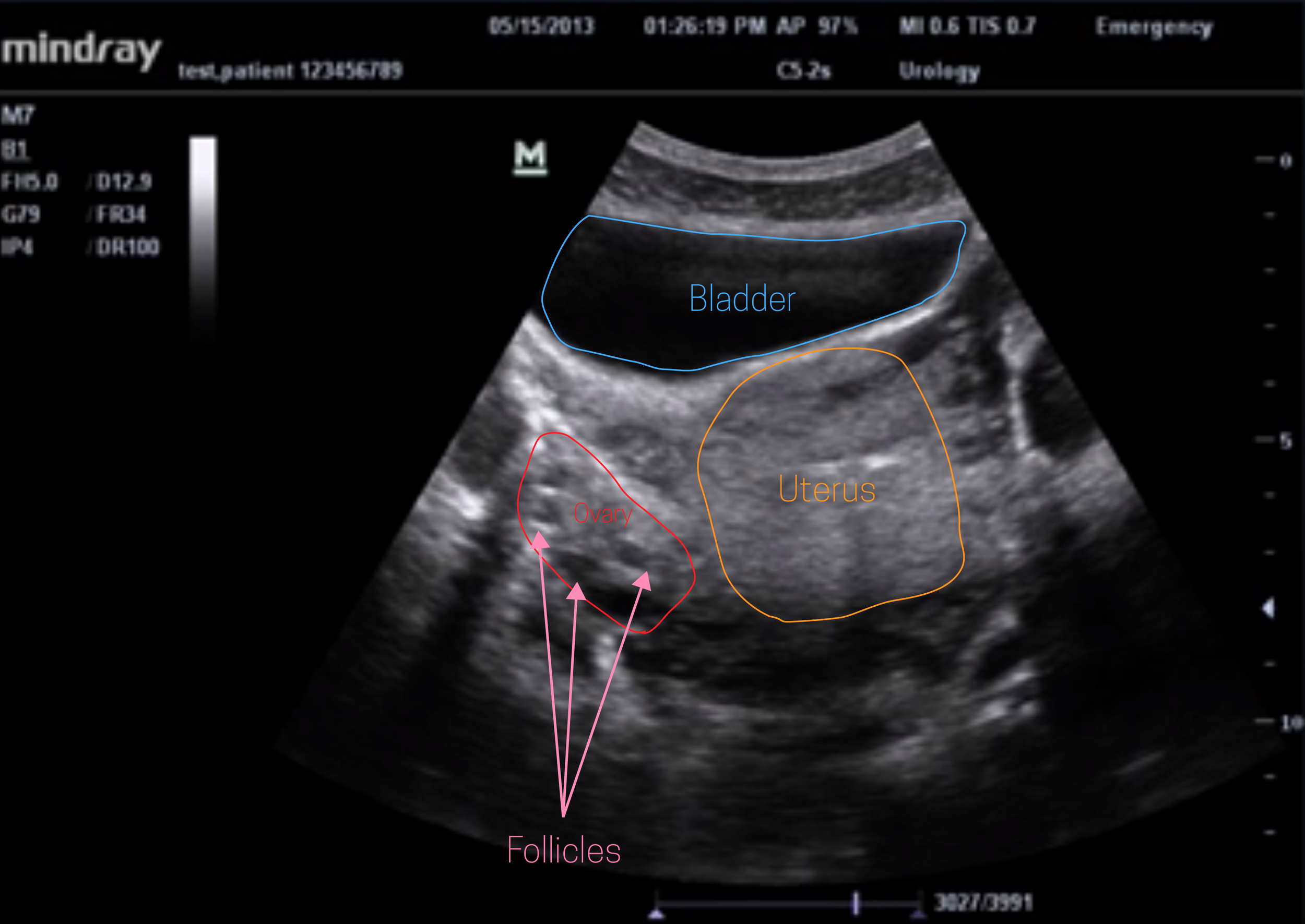 Transvaginal ultrasound scan illustrating left adnexal 