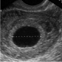 Gestational Sac on Transverse Abdominal USG.png