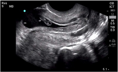 From Chrestiana et al. Pitfalls in cervical ectopic pregnancy diagnosis by emergency physician using bedside ultrasonography. 