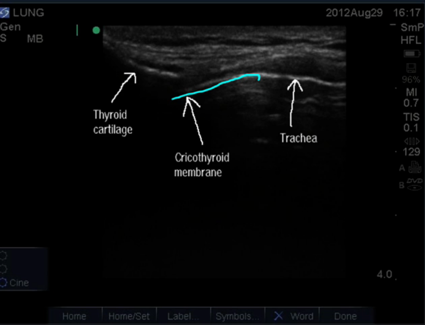 Sagittal view of the cricothyroid membrane from Ultrasound Leadership Academy. 
