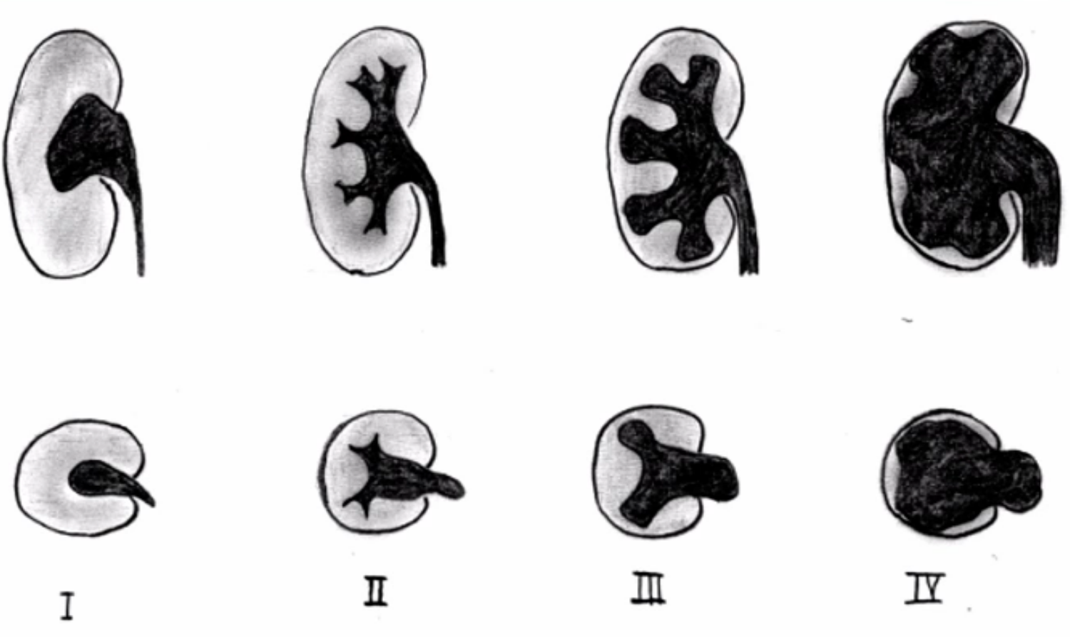 Grading of Hydronephrosis