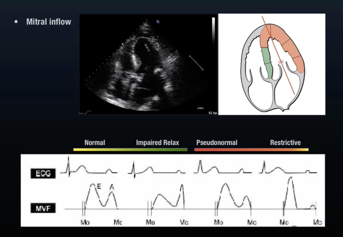 Mitral Inflow Velocity Waveforms From ULA Diastology 