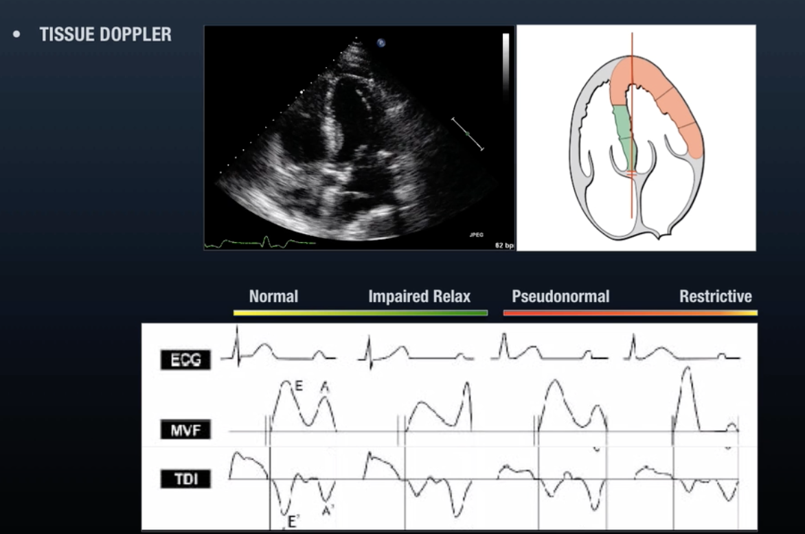 Tissue Doppler Waveforms From ULA Diastology 