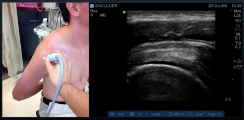 Proper Probe Location for Supraspinatus Long Axis View