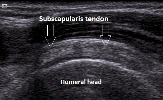 Anatomy of the Subscapularis