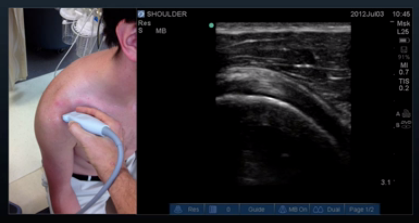 Proper Probe Location for Subscapularis Long Axis View