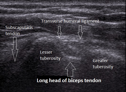 Anatomy of the Biceps Tendon Short Axis