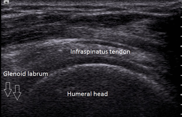 Anatomy of the Infraspinatus Tendon in Long Axis