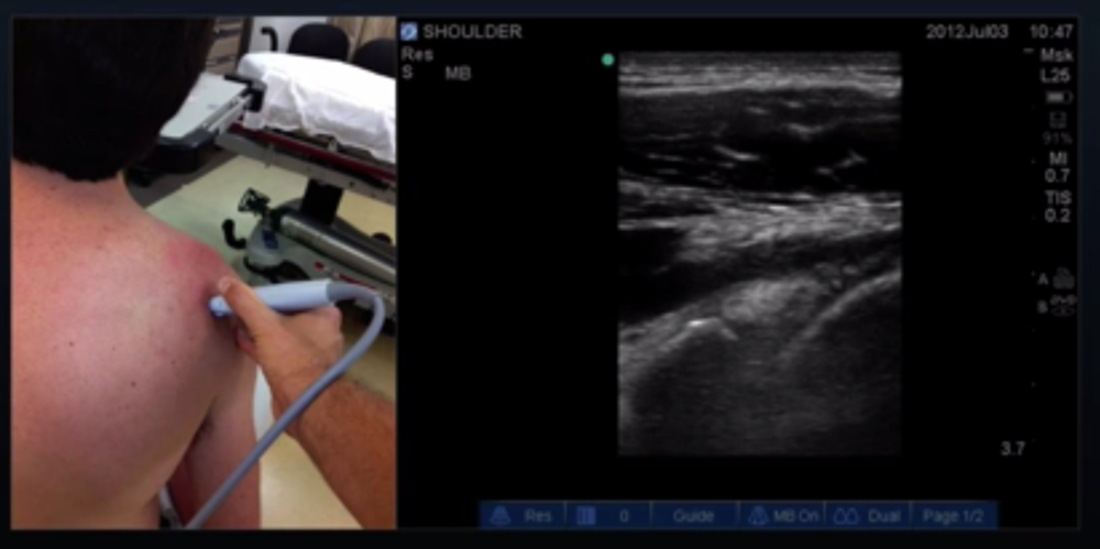 Proper Probe Location for Infraspinatus Tendon Long Axis View