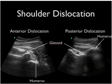 Shoulder Dislocation