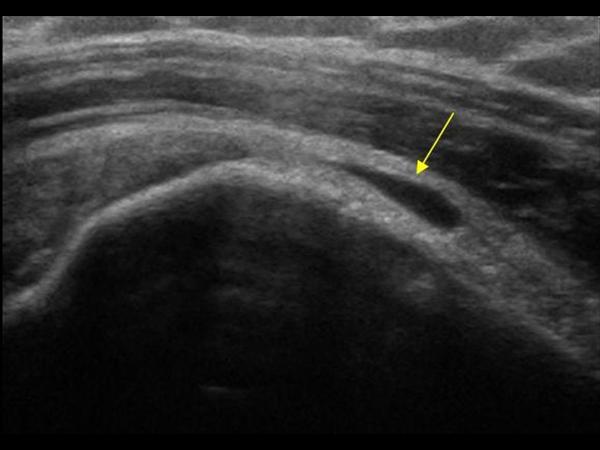 Acute Bursitis 