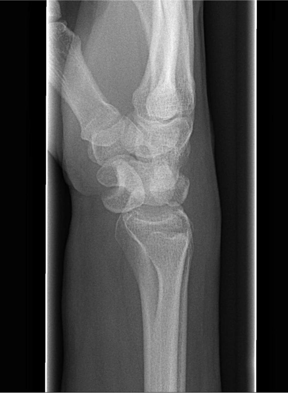 Lateral Wrist X-ray