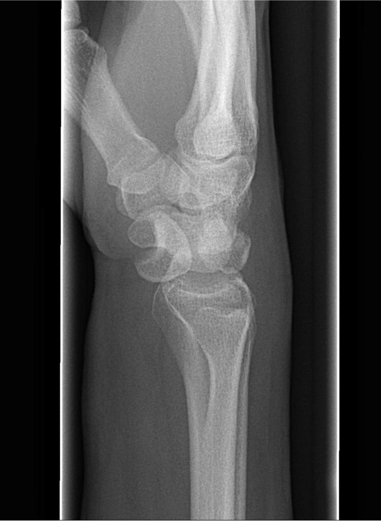 wrist xray normal wrist xray normal
