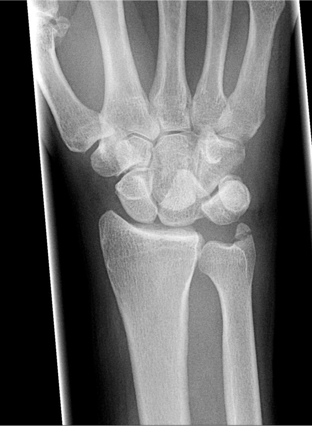 AP Wrist X-Ray