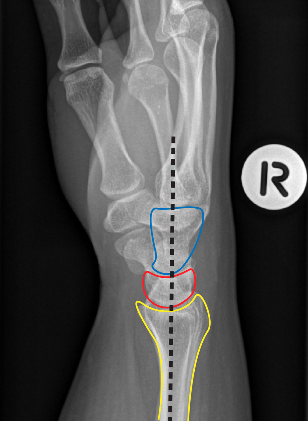 Normal Radiocarpal Alignment