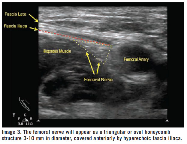 Additional ultrasound imaging of femoral nerve block anatomy.