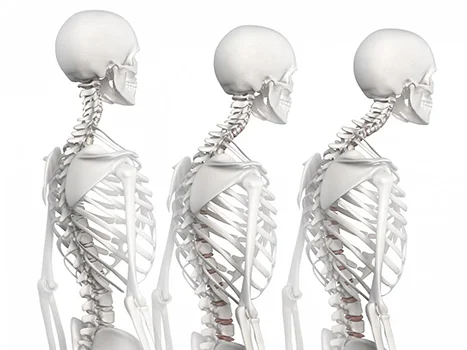 Fig. C: The shoulder blades are tend to tilt forward and the head protrudes when we have rounded shoulders