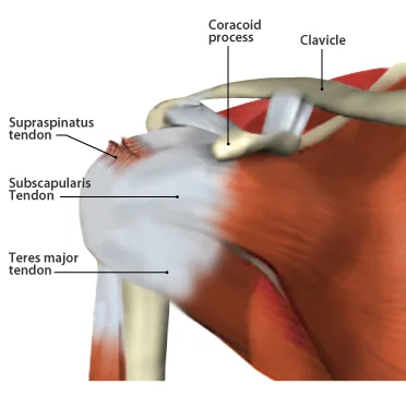 Rotator cuff tear in the tendon of the supraspinatus muscle.