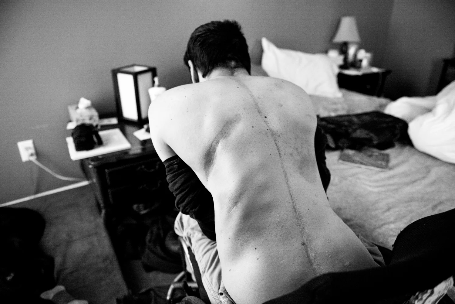 David pauses as he changes to take a nap after rugby practice. David usually takes at least one nap a day because his body gets tired and has frequent spasms. David has a port on his right side that gives an antispasmodic directly to his spine.